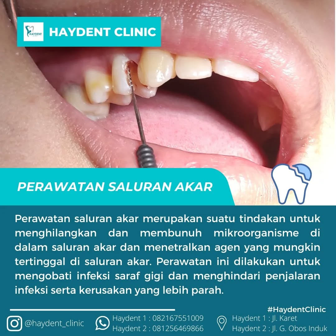 Perawatan saluran akar (PSA) merupakan perawatan gigi yang bertujuan mempertahankan gigi agar dapat tetap berfungsi di dalam mulut